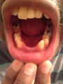 Dental Bridges & Whitening
