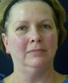 Affirm Co2 Skin Resurfacing - Laser Skin Toning