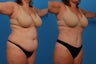 Tummy Tuck: 41-Year-Old Female
