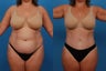 Tummy Tuck: 41-Year-Old Female