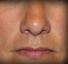 Rhinoplasty