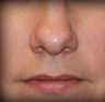 Rhinoplasty