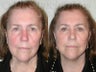 SLUPlift (Mini-lift procedure)