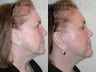 SLUPlift (Mini-lift procedure)