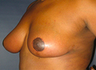 Breast Lift
