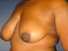 Breast Lift
