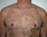 Adult Male treated for Breast Reduction
