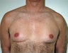 Adult Male treated for Breast Reduction