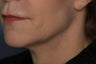Female treated for Sagging Skin at Jawline
