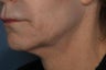 Female treated for Sagging Skin at Jawline