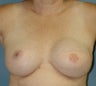 Breast Reconstruction