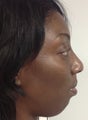 36 year old Non surgical Rhinoplasty
