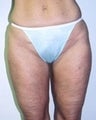 Female patient who underwent a thigh lift