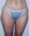 Female patient who underwent a thigh lift