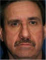 55 year old man with under eye puffiness, sagging jaw line and cheeks due to facial volume loss