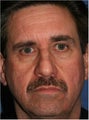 55 year old man with under eye puffiness, sagging jaw line and cheeks due to facial volume loss