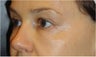 Restylane