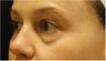Restylane