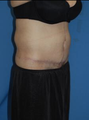 Circumferential Tuck