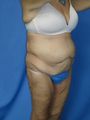 Circumferential Tuck