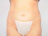 Female Liposuction