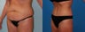 Tummy Tuck: 42-Year-Old Woman