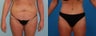 Tummy Tuck: 42-Year-Old Woman