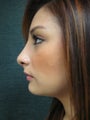 Female who underwent Rhinoplasty