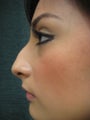 Female who underwent Rhinoplasty