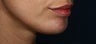 29 Year Old Chin Augmentation
