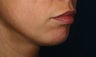 29 Year Old Chin Augmentation