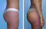 Brazilian Butt Lift Before & After