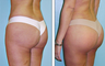 Brazilian Butt Lift Before & After