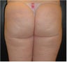 SmartLipo MPX