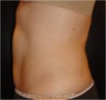 SmartLipo MPX