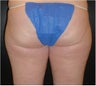 SmartLipo MPX