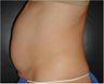 SmartLipo MPX