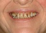 Full Mouth Reconstruction