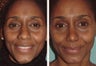 Attractive African American actress in her mid-twenties who felt her nose was larger than her other features