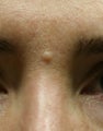 Mole Removal