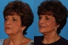 Facial Rejuvenation: 67-Year-Old Woman
