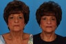 Facial Rejuvenation: 67-Year-Old Woman