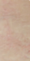 Tattoo Removal Before & After
