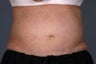 Liposonix