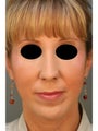 Female Revision Rhinoplasty