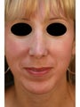 Female Revision Rhinoplasty