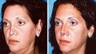 Nasal Dorsum Collapse, Tip Asymmetry with Scarring