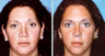 Nasal Dorsum Collapse, Tip Asymmetry with Scarring