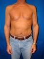 Pectoral Implants