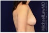Breast Lift